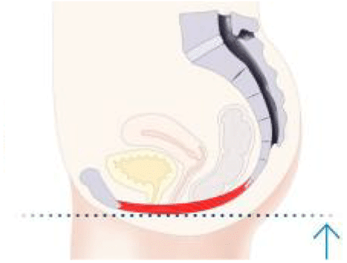 après le traitement - Amélioration du contrôle pelvien Schéma du plancher pelvien après traitement montrant un meilleur tonus musculaire et un contrôle amélioré de la vessie