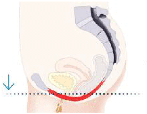 Avant traitement - Faiblesse du plancher pelvien Schéma du plancher pelvien avant traitement montrant une faiblesse musculaire affectant le contrôle de la vessie.